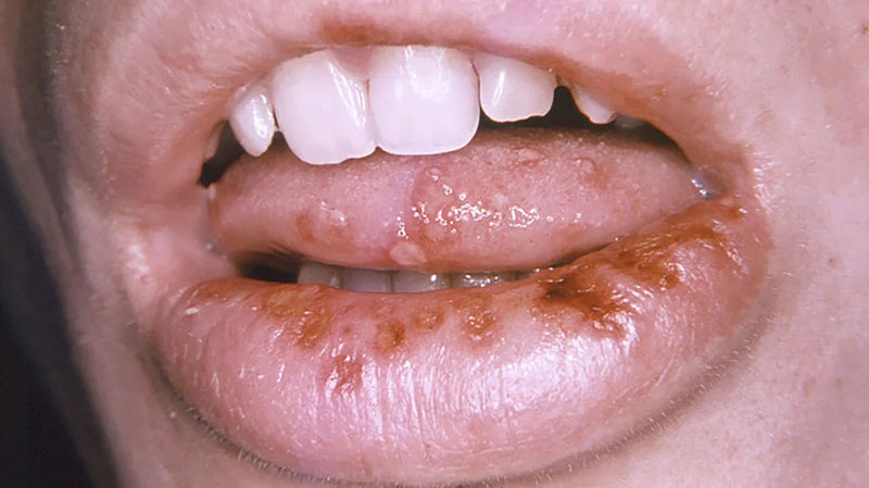 Mụn nước trong miệng cũng là biểu hiện của bệnh mụn rộp sinh dục