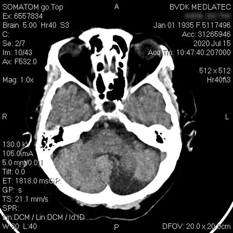 Chụp CT sọ não để chẩn đoán bệnh