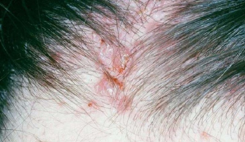 Mụn trên da đầu có thể mọc dưới chân tóc hoặc nổi khắp bề mặt da