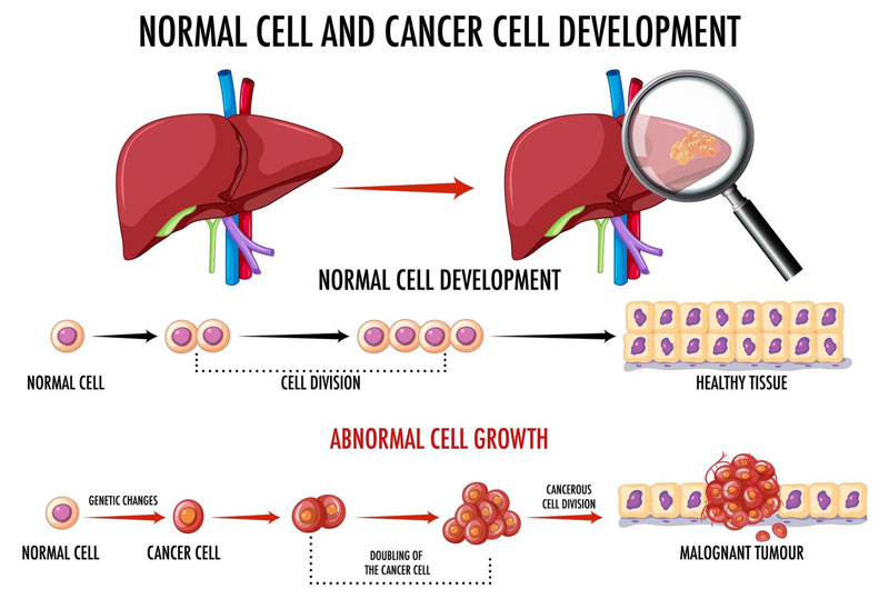 Ung thư gan hình thành do sự phát triển mất kiểm soát của tế bào ung thư