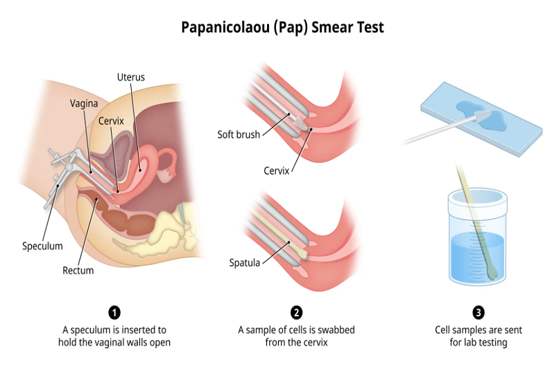 Mô phỏng quy trình tiến hành xét nghiệm Pap smear