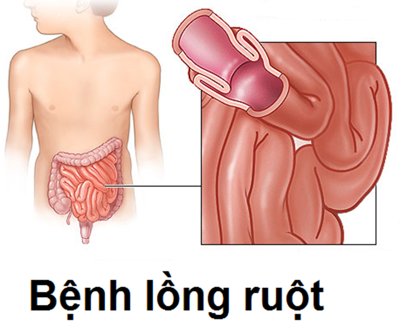 Lồng ruột ở trẻ thường để lại nhiều di chứng nặng nếu không được điều trị kịp thời