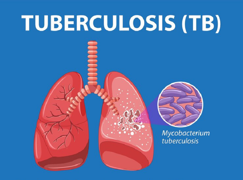 Vi khuẩn lao xâm nhập, kí sinh gây nên bệnh lao phổi