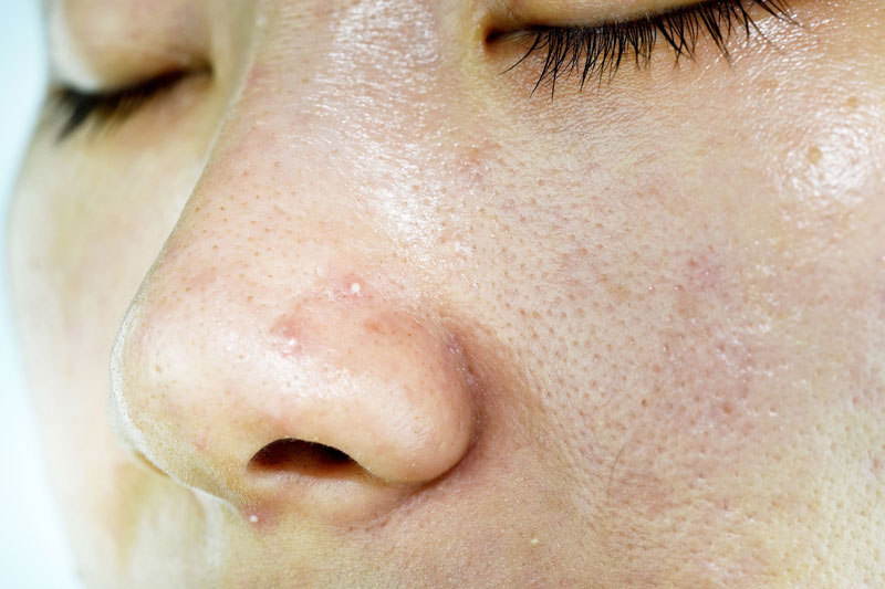 Mồ hôi dầu tiết ra quá mức có ảnh hưởng không tốt với sức khỏe làn da