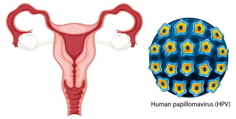 HPV là tác nhân chính gây bệnh