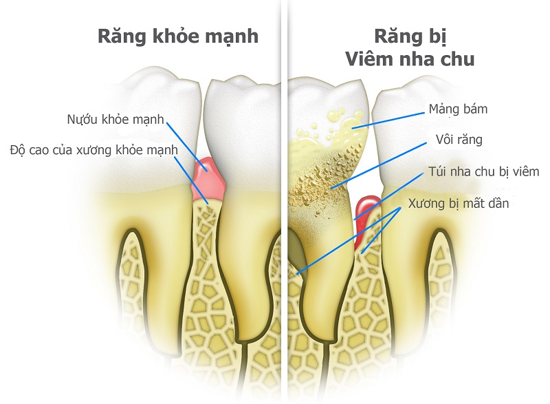Bệnh viêm nha chu có gây tổn thương cho mô xung quanh răng không?
