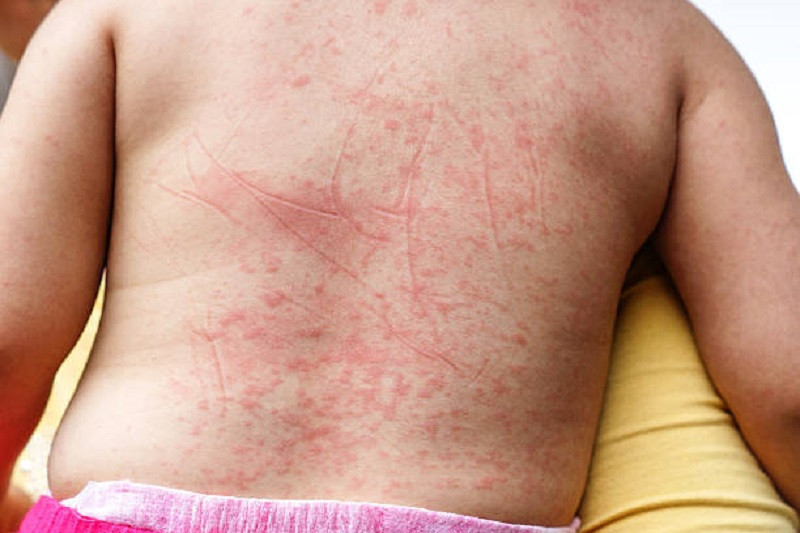 Nổi mẩn đỏ, phát ban là triệu chứng thường gặp của sốt xuất huyết
