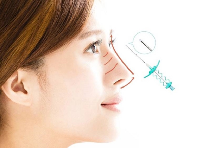 Căng chỉ mũi là phương pháp ít xâm lấn, dùng chỉ tự tiêu luồn sâu dưới da để cố định mô mũi, giúp cải thiện sống mũi