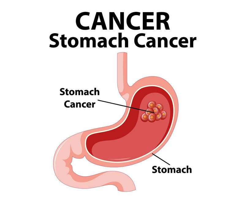 Ung thư dạ dày là tình trạng tế bào ở niêm mạc dạ dày phát triển không kiểm soát