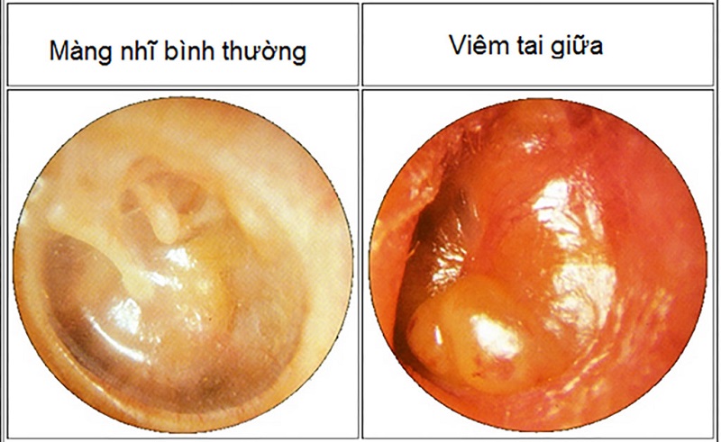 Hình ảnh cho thấy viêm nhiễm xảy ra ở vùng tai giữa