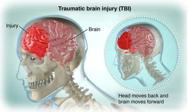 Chi tiết về di chứng của dập não và cách điều trị hiệu quả