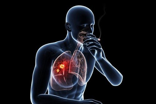 hiểu lầm về ung thư phổi