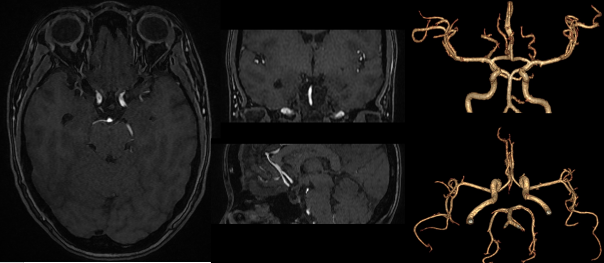 MRI mạch máu não