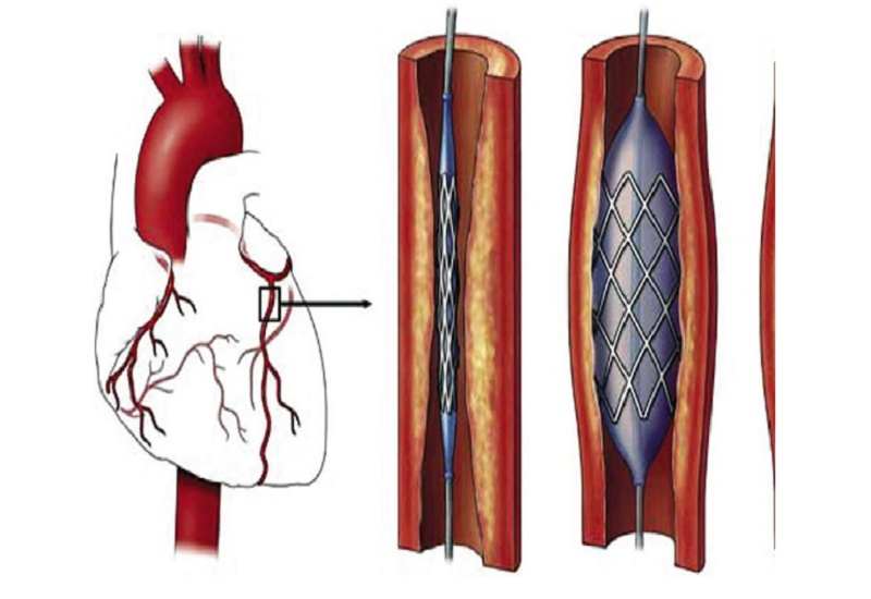 chụp MRI mạch vành