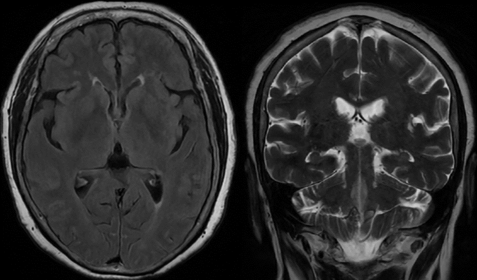 Chụp MRI não