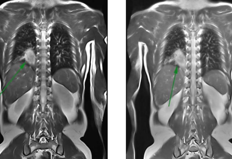 chụp MRI toàn thân