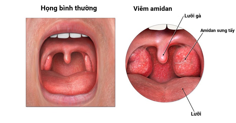 Sự khác biệt giữa hình ảnh vòm họng người bình thường và người bị viêm amidan