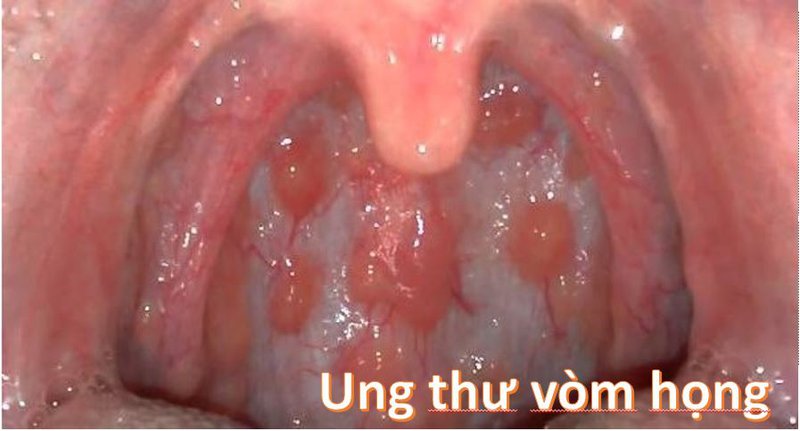 Hình ảnh cho thấy triệu chứng bất thường ở người bị ung thư vòm họng