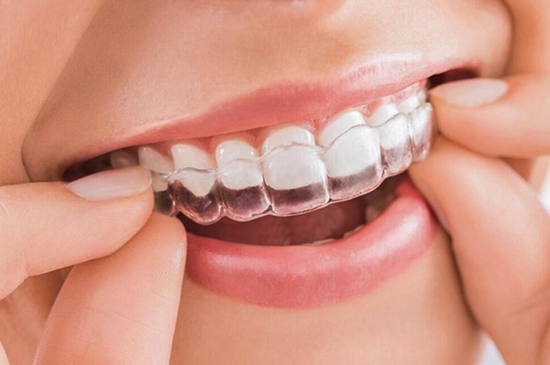  Niềng răng trong suốt : Bí quyết để có hàm răng sáng bóng