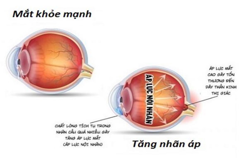 Thuốc nhỏ mắt Azopt dùng trong điều trị tăng nhãn áp