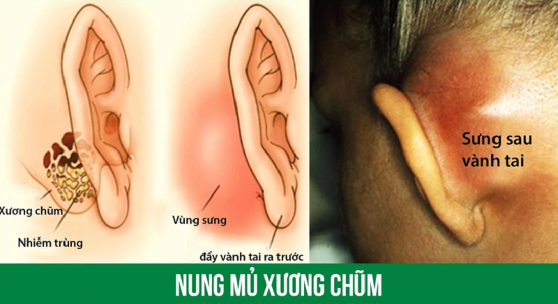 Viêm tai xương chũm là một trong các bệnh về tai có thể gây mất thính giác
