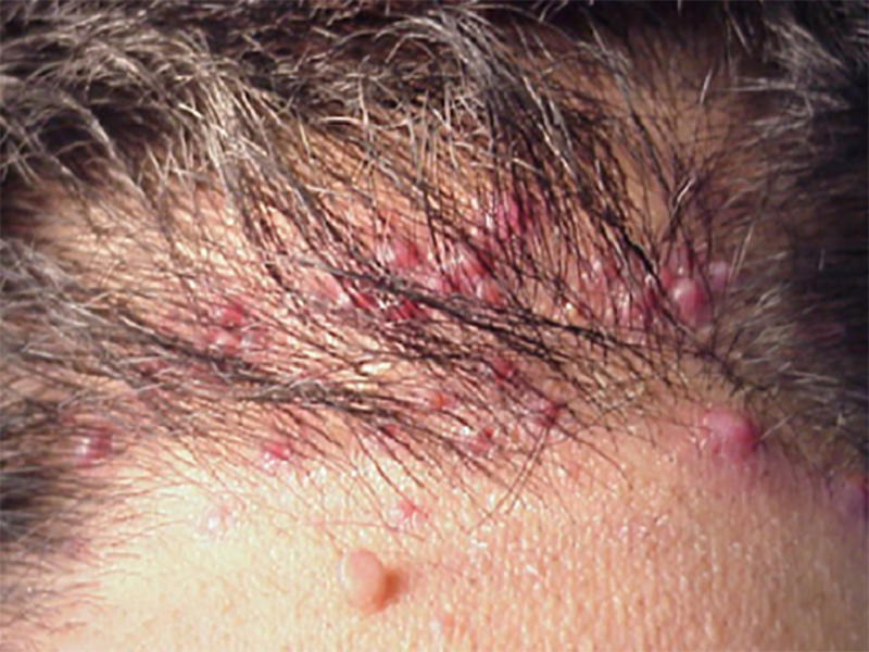 Viêm chân tóc khiến cho người bệnh cảm thấy đau da đầu khi chạm nhẹ vào tóc
