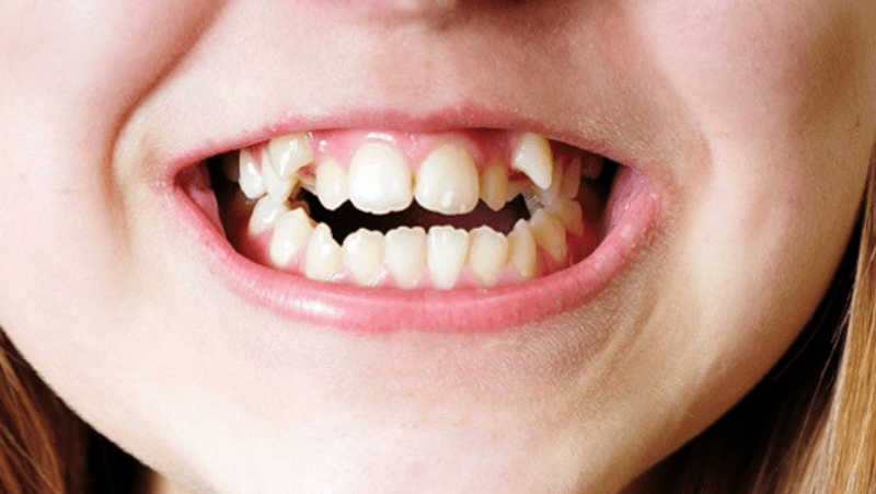 Người trưởng thành thông thường có bao nhiêu chiếc răng nanh?
