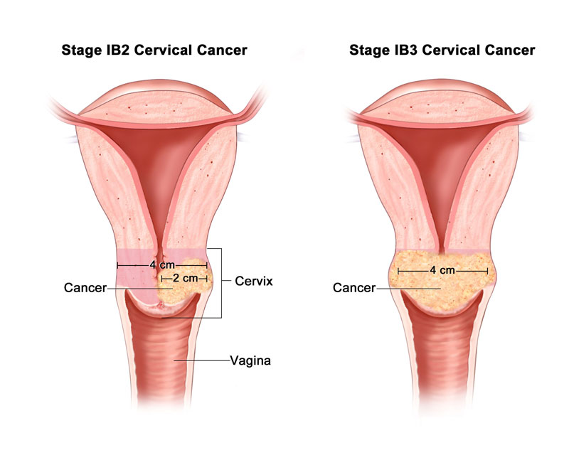 Ung thư cổ tử cung là căn bệnh nguy hiểm ở nữ giới