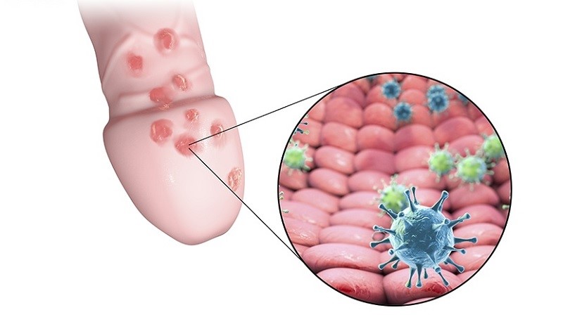 Người nhiễm virus HSV có thể xuất hiện các nốt mụn nước, lở loét ở cơ quan sinh dục