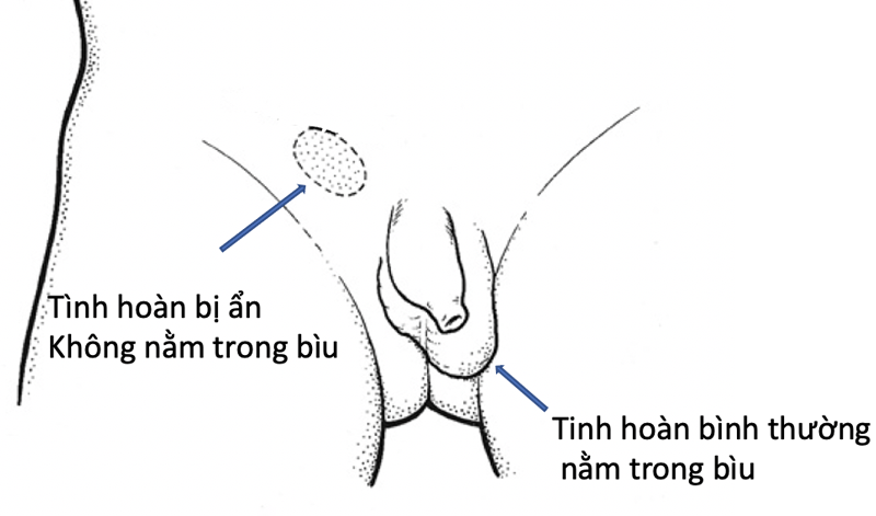 Hình ảnh minh họa tinh hoàn ẩn ở trẻ