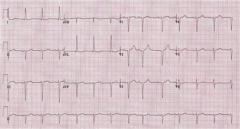 Tại sao điện tâm đồ suy tim quan trọng trong việc chẩn đoán và giám sát suy tim?
