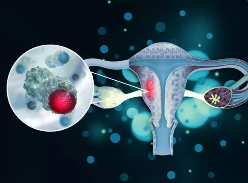 Tình trạng viêm nhiễm có thể dẫn đến hình thành cục u trong cổ tử cung