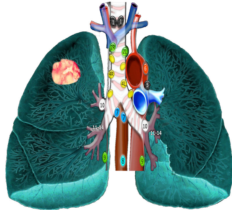 Tế bào ung thư có thể di căn từ phổi tới hạch trung thất