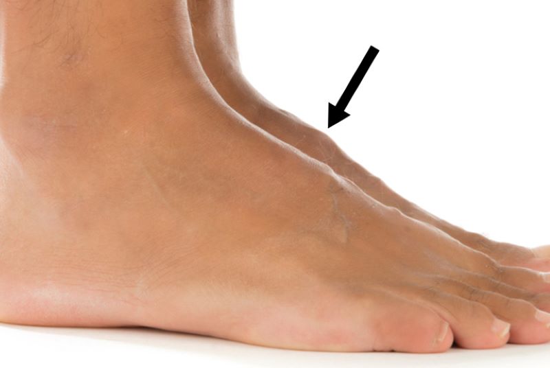 Khối u nổi ở chân có thể là dấu hiệu cảnh báo bệnh lý