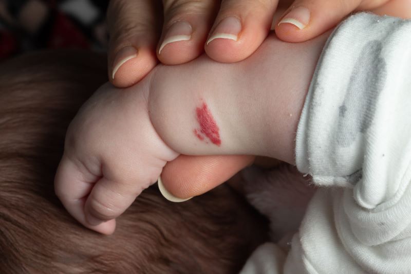 Có thể nhận biết u máu ở trẻ thông qua vết bớt đỏ hoặc xanh nhạt nổi trên da