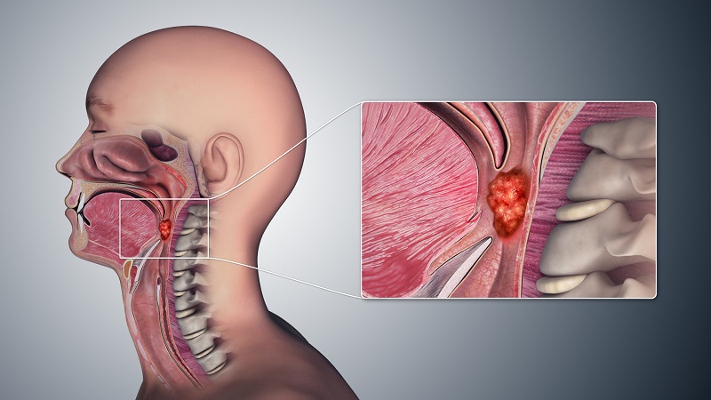 Để chẩn đoán ung thư vòm họng, bác sĩ thường chỉ định nội soi 