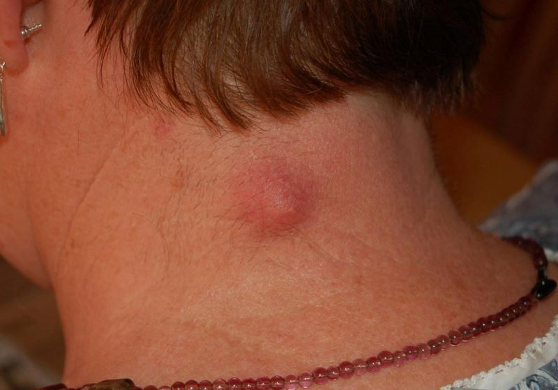 Mụn mọc sau gáy có thể xuất phát từ một số bệnh lý trên da