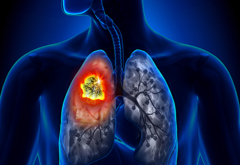  U phổi ác tính : Tìm hiểu ngay những thực phẩm bổ dưỡng