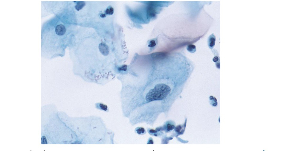 Hình ảnh tế bào vảy không điển hình với khoảng sáng bào tương không rõ trên nền viêm.