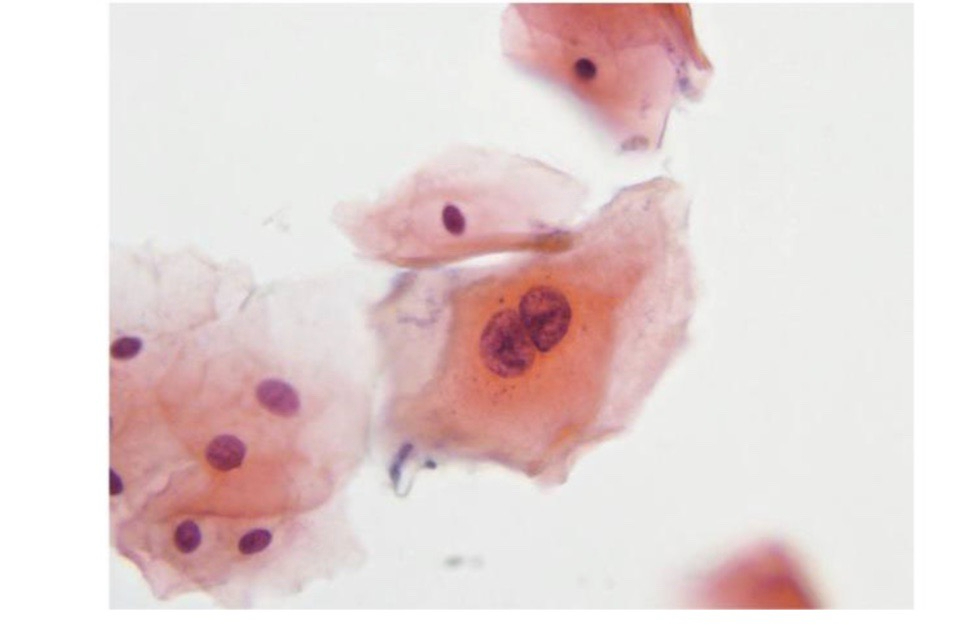 Hình ảnh tế bào vảy không điển hình có hai nhân và bào tương màu cam, không đủ chẩn đoán LSIL