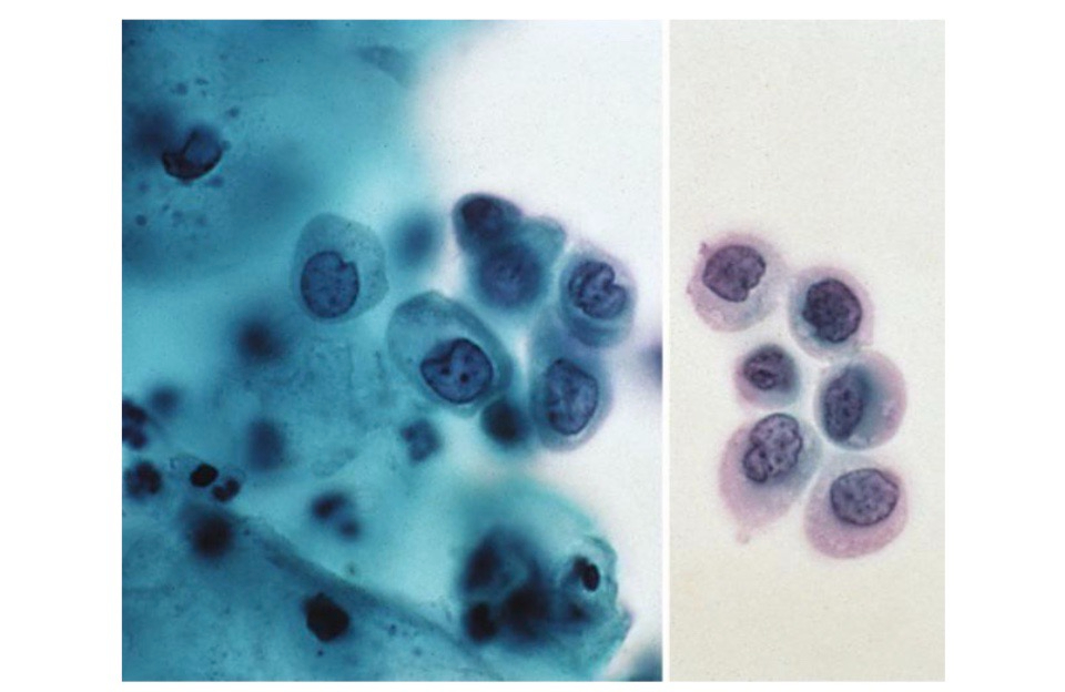 Các tế bào ASC-H với nhân méo mó, tỉ lệ nhân/bào tương tăng, màng nhân không đều.