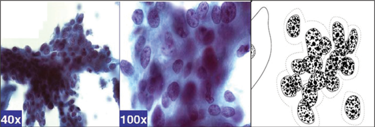 Hình ảnh hợp bào của HSIL biểu hiện các nhóm tế bào đông đúc, không có viền ranh giới giữa các tế bào. Nhân tăng sắc, khác nhau về kích thước, chất nhiễm sắc dạng hạt thô.