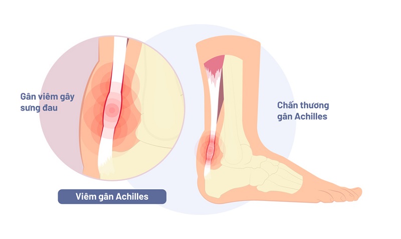 Bệnh viêm gân là một trong các nguyên nhân dẫn đến cổ chân bị đau khi chạy bộ