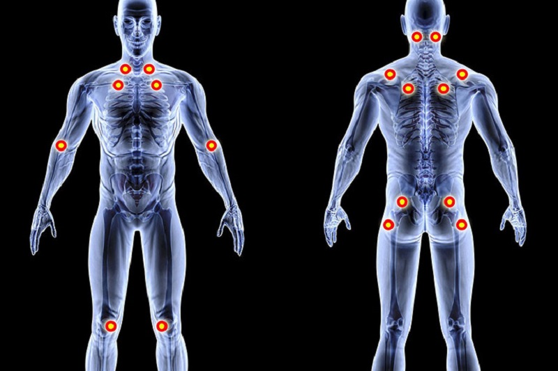 Cơn đau cơ xơ hóa có thể xảy ra ở bất cứ vùng nào của cơ thể