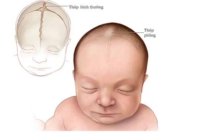 Thóp trẻ sơ sinh bị phồng là hiện tượng bất thường cần được kiểm tra