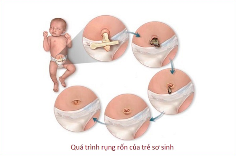 Mô tả về quá trình rụng rốn bình thường ở trẻ sơ sinh