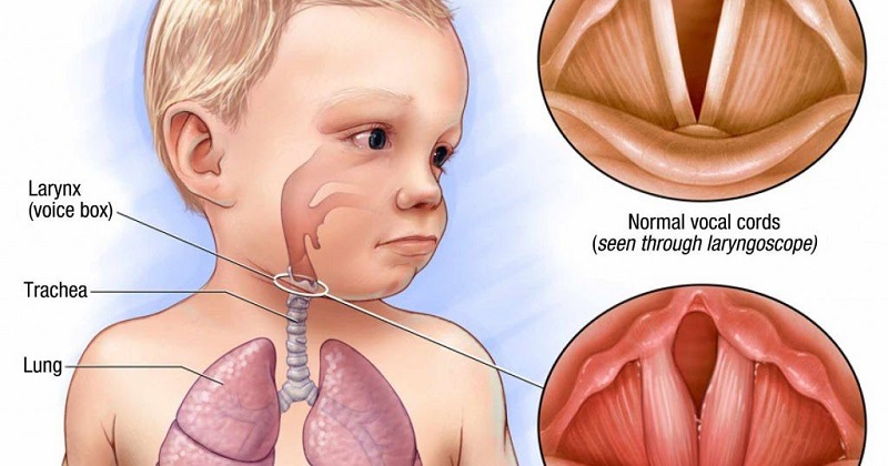 Mềm sụn thanh quản là bệnh lý phổ biến khiến trẻ thở rít