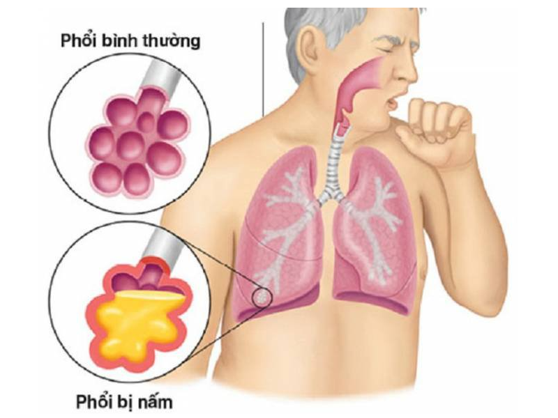 Sự khác biệt giữa phổi bình thường và phổi của người bị nấm phổi