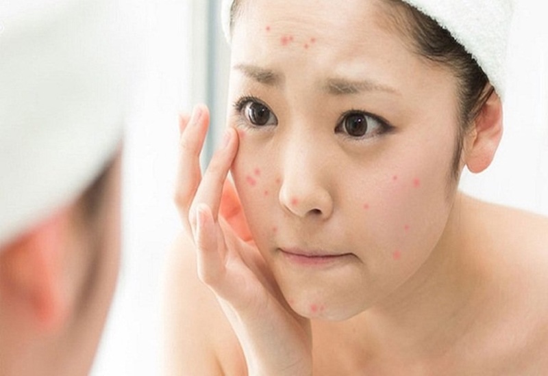 Thuốc uống Acnes có chứa thành phần retinoid không?
