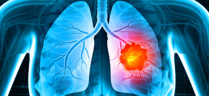 Bệnh ung thư phổi là nguyên nhân gây tử vong ở nhiều người